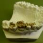 Gouden inlay's