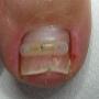nagelbeugel