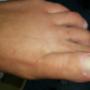 nagelbeugel
