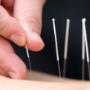 acupunctuur