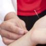 acupunctuur
