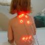 laser acupunctuur