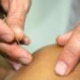 Dry Needling
