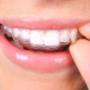 Invisalign onzichtbare beugel