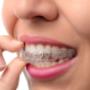 Invisalign beugel