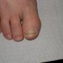 Nagelbeugel