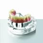 prothese op implantaten