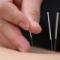 Dry Needling
