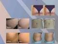 Anti-Cellulite Massage