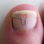 Nagelbeugel