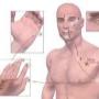 acupunctuur1