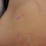 Dry Needling / TNC