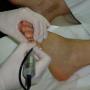 Behandeling nagels frezen