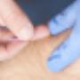 dry_needling_fysio_alphen_slid