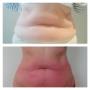 Resultaat Venus Freeze Plus
