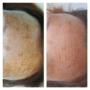 Resultaat pigmentbehandeling