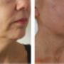 Resultaat Venus Freeze Plus