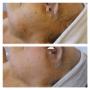Resultaat pigmentbehandeling