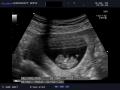 Echoscopie