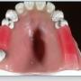 partiele_prothese_waswallen.pn