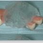 partiele_prothese_met_ankers1.