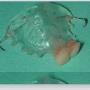 partiele_prothese_met_ankers2.