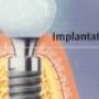 implantologie
