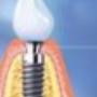 Implantaten_202011_20versie_20