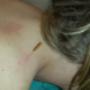 Dry Needling