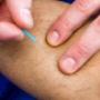 Dry Needling