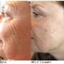 Dermatude The Facelift Alternative