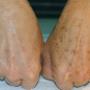 1 hand behandeld tegen pigment