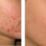 Behandeling van acne