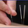 Dry needling
