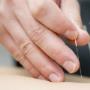 Dry Needling