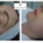 Acne gezicht voor en na