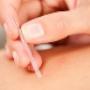 Dry Needling