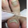 Nagelregulatie (beugel)