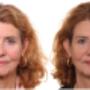 Botox Clinic 28 Rimpelbehandeling
