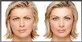Botox