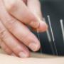 Dry needling