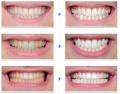 Tanden bleken Teeth whitening