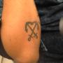 Tattoo verwijdering  -voor behandeling-