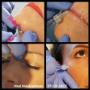 Botox, fillers, draadlifts