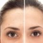 Anti-pigment vlekken