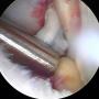 Artroscopie knie kruisband