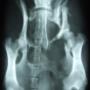 Multipele Bekken fracturen