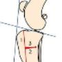 Knie TTO operatie kruisband 1