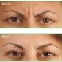 botox fronsbehandeling