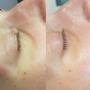 Resultaat na 1x HydroPeptide behandeling
